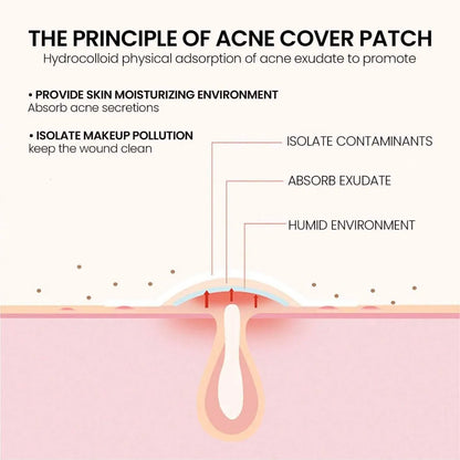 Star Hydrocolloid Acne Patches – 200pcs in 5 Cute Colors