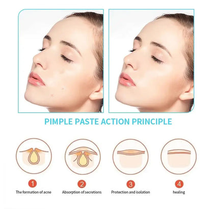 Hydrocolloid Salicylic Acne Patches – 30pcs Pimple Spot Treatment